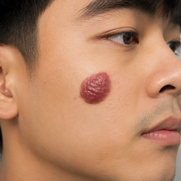 ปานสตรอเบอร์รี่ (Hemangioma)