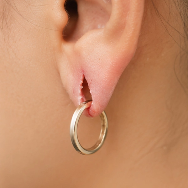อุบัติเหตุหูฉีกขาดเฉียบพลัน-Acute-Trauma