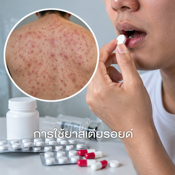 การใช้ยาสเตียรอยด์