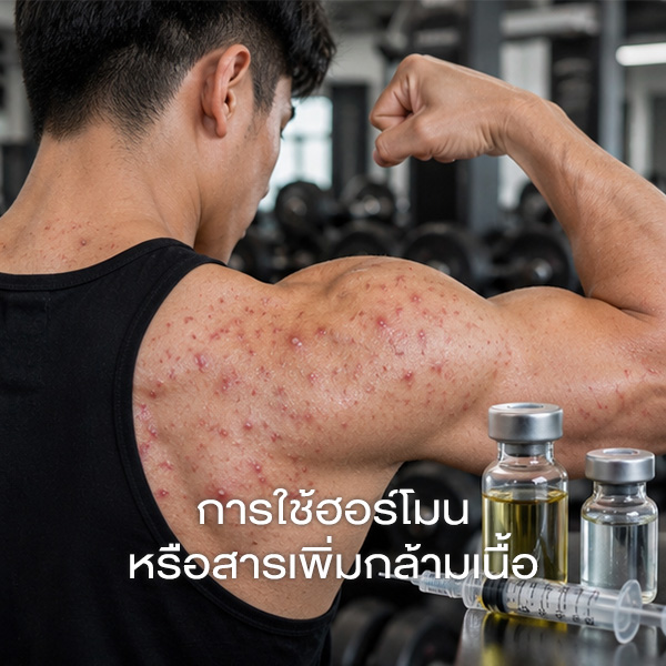 การใช้ฮอร์โมนหรือสารเพิ่มกล้ามเนื้อ