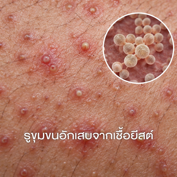 รูขุมขนอักเสบจากเชื้อยีสต์