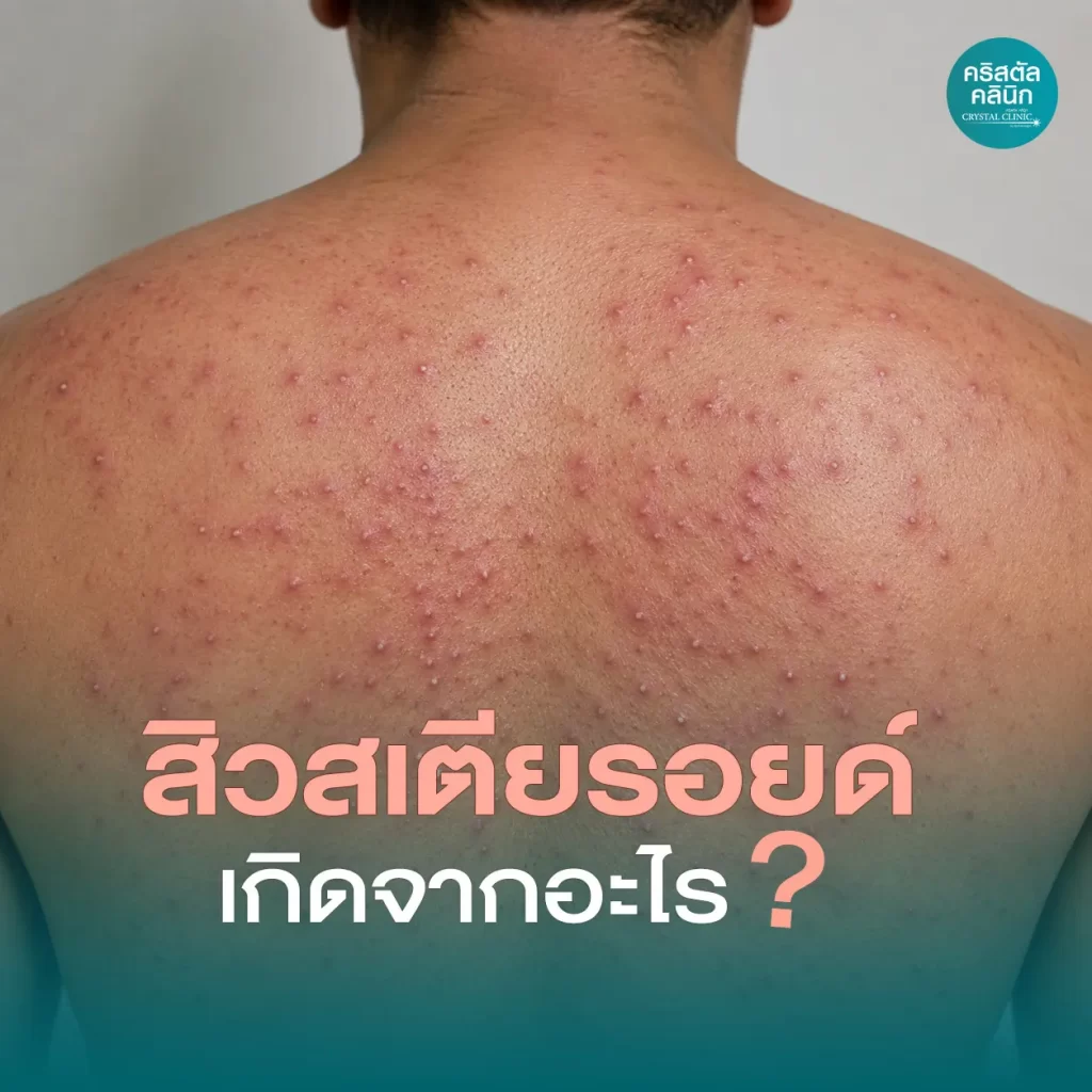 สิวสเตียรอยด์-เกิดจากอะไร