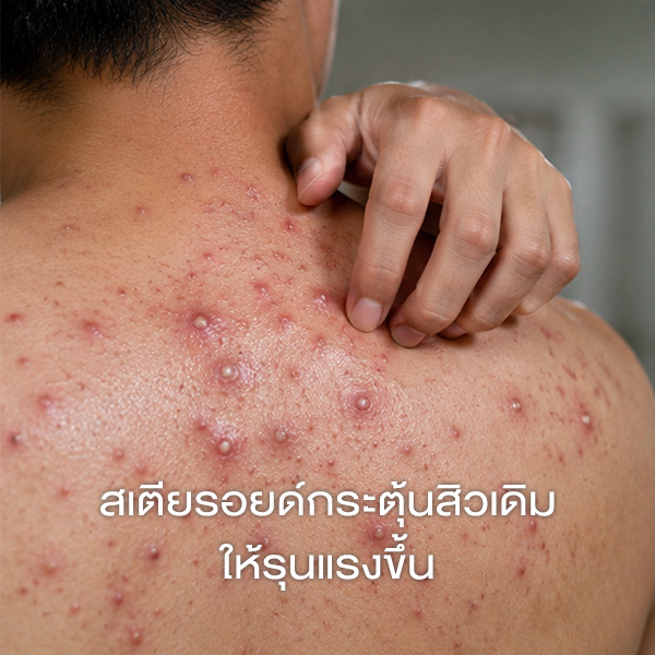 สเตียรอยด์กระตุ้นสิวเดิมให้รุนแรงขึ้น