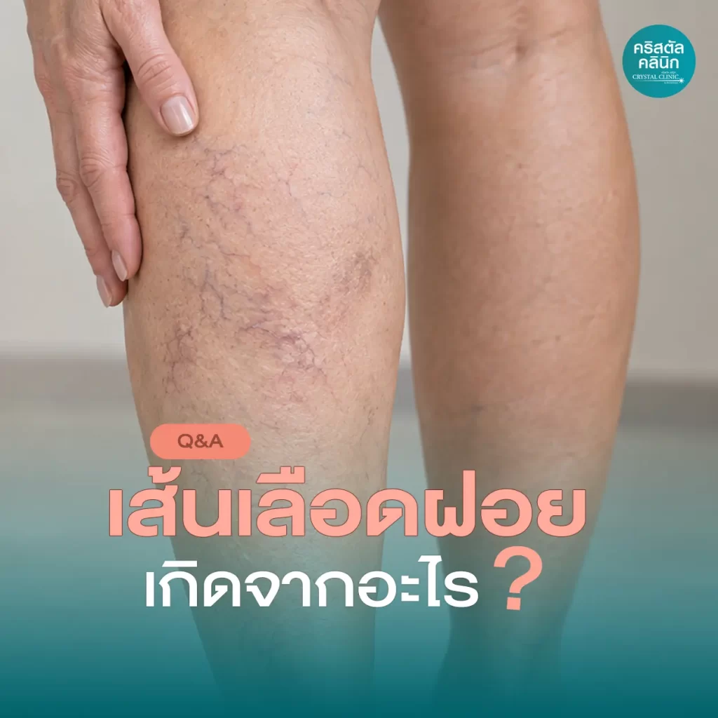 เส้นเลือดฝอย เกิดจากอะไร